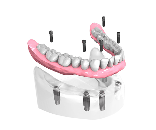 Implant dentaire Touquet